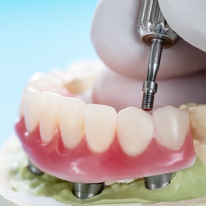 A close-up of a full-arch dental prosthetic being secured into a model with four titanium implant posts, demonstrating full-mouth restoration technology.