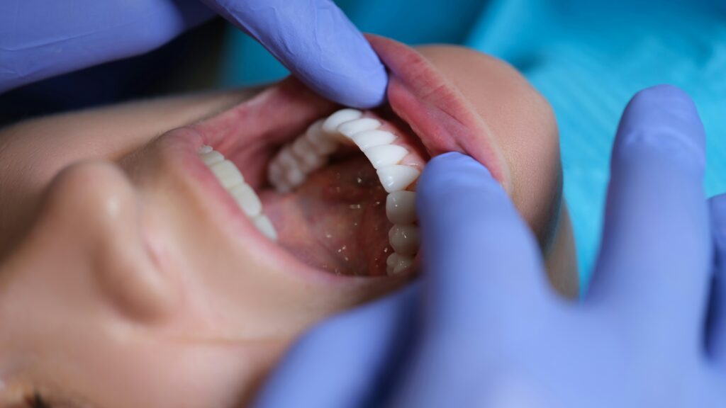 A close-up view of a patient’s open mouth during a dental examination, with a provider in blue medical gloves gently retracting the lip to inspect the upper teeth and gum line.