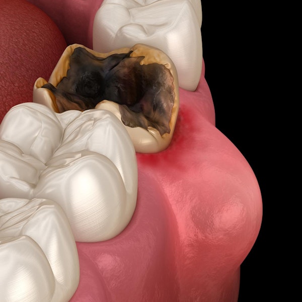 A 3D medical illustration of a severely decayed molar tooth with blackened enamel and inflamed, red gums, situated between two healthy white teeth.