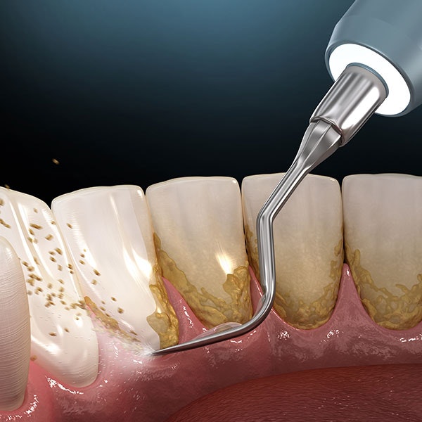 A professional medical illustration of an ultrasonic dental scaler removing yellow plaque and tartar deposits from teeth and the gum line during a scaling and root planing procedure.