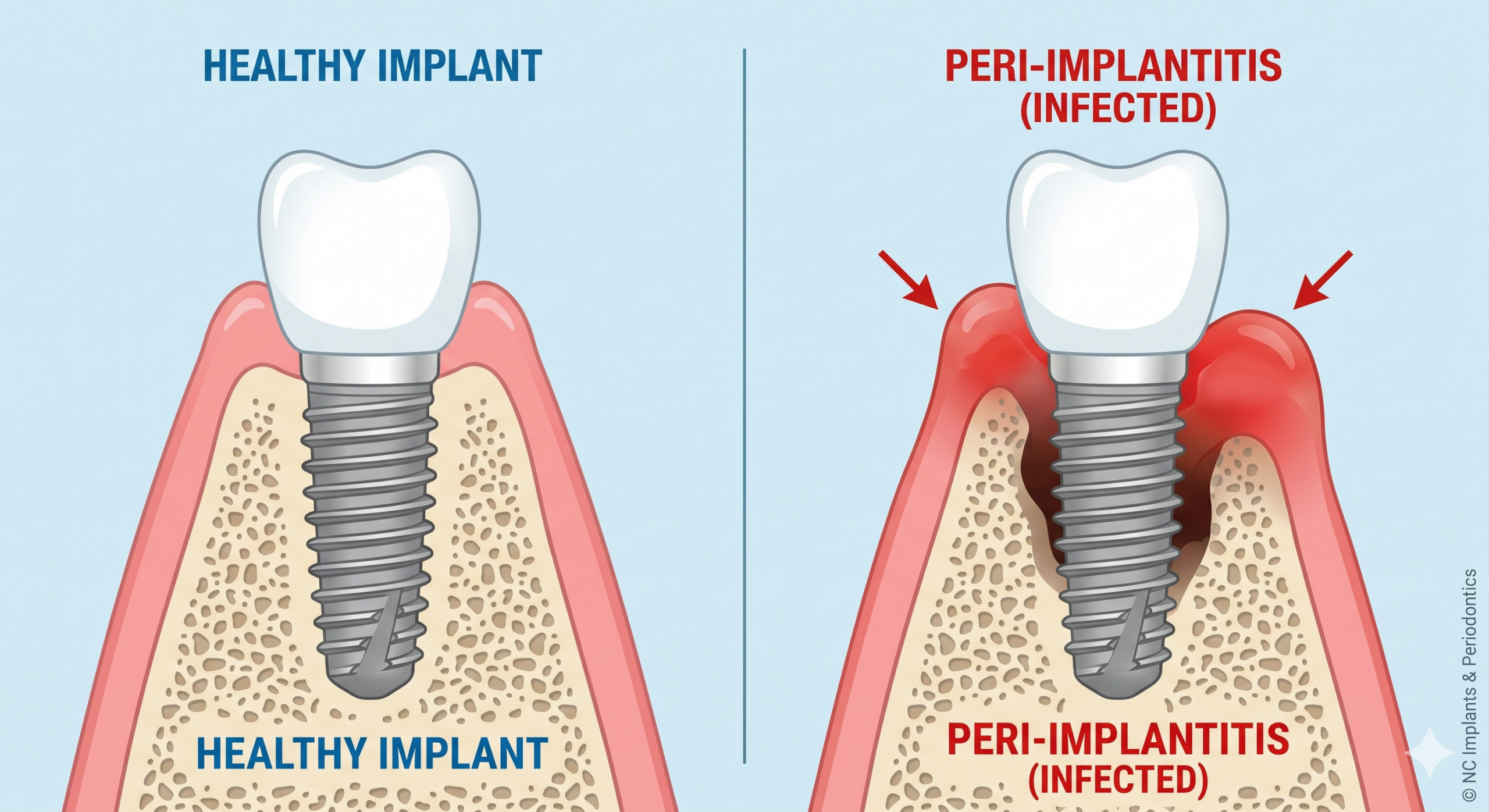 Medical infographic comparison illustrating the anatomical differences between a healthy dental implant and an infected implant suffering from peri-implantitis.