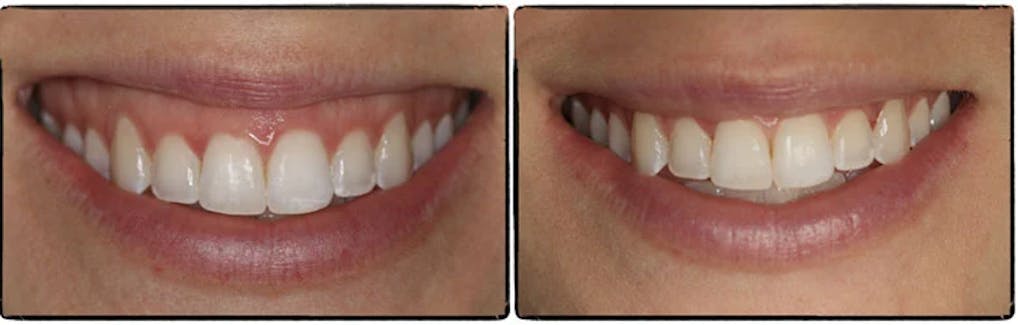 Before and after lip repositioning surgery results showing gummy smile reduction in a Raleigh, NC patient.