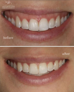 Before-and-after gummy smile treatment showing excessive gum display reduction by Dr. Thiago Morelli at North Carolina Implants and Periodontics.